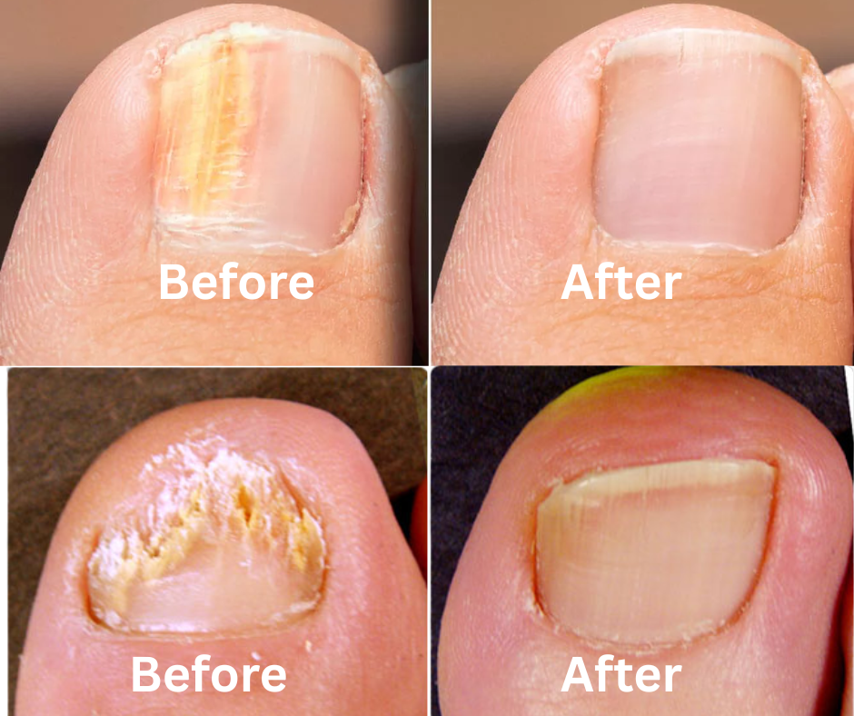 Provided before-and-after toenail comparison